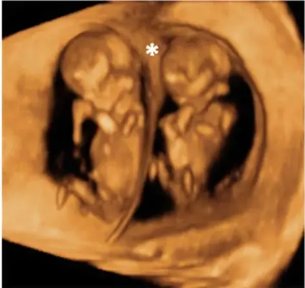 img of Conversación entre dos bebés en el vientre de su madre